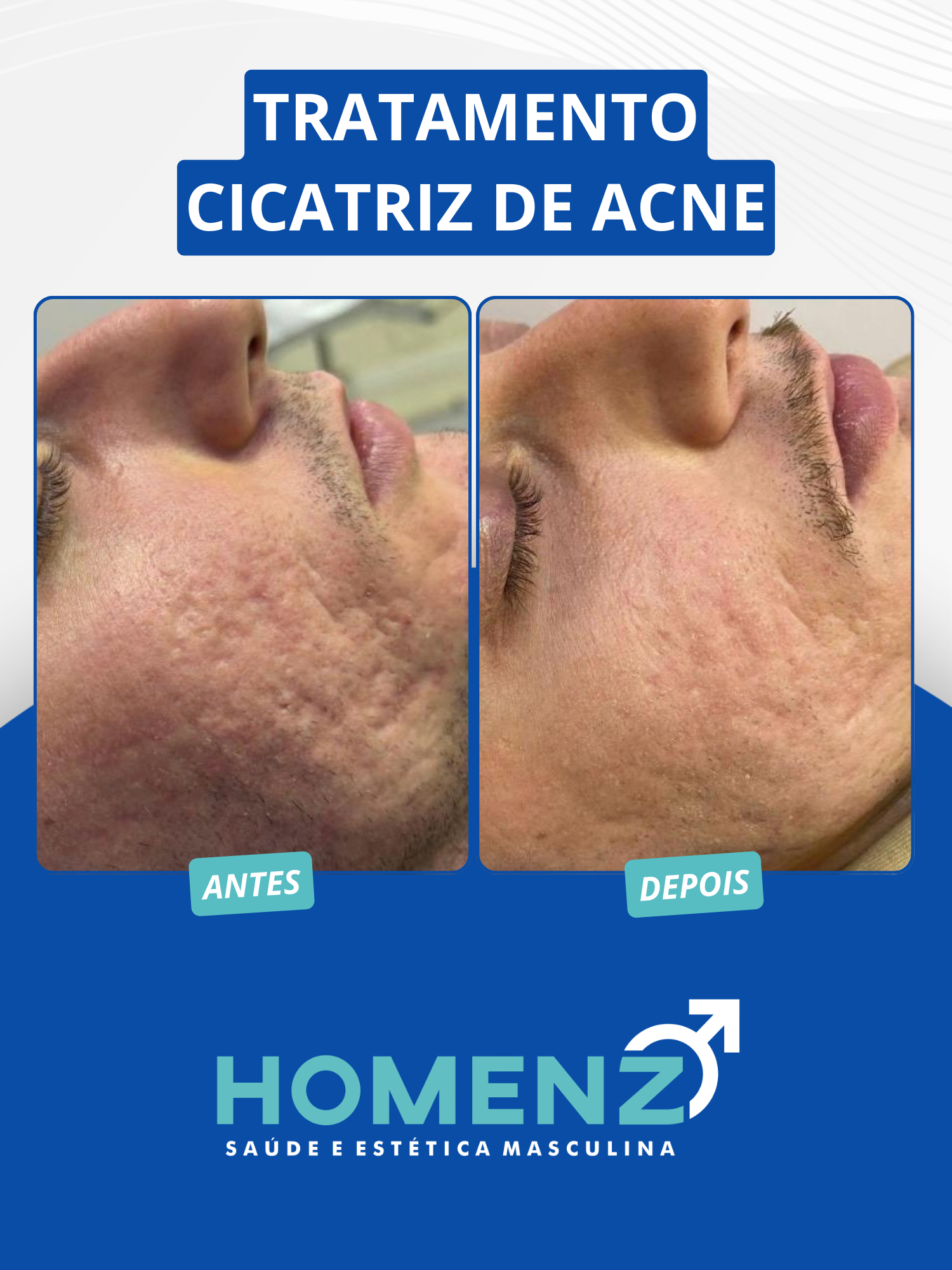 ACNE