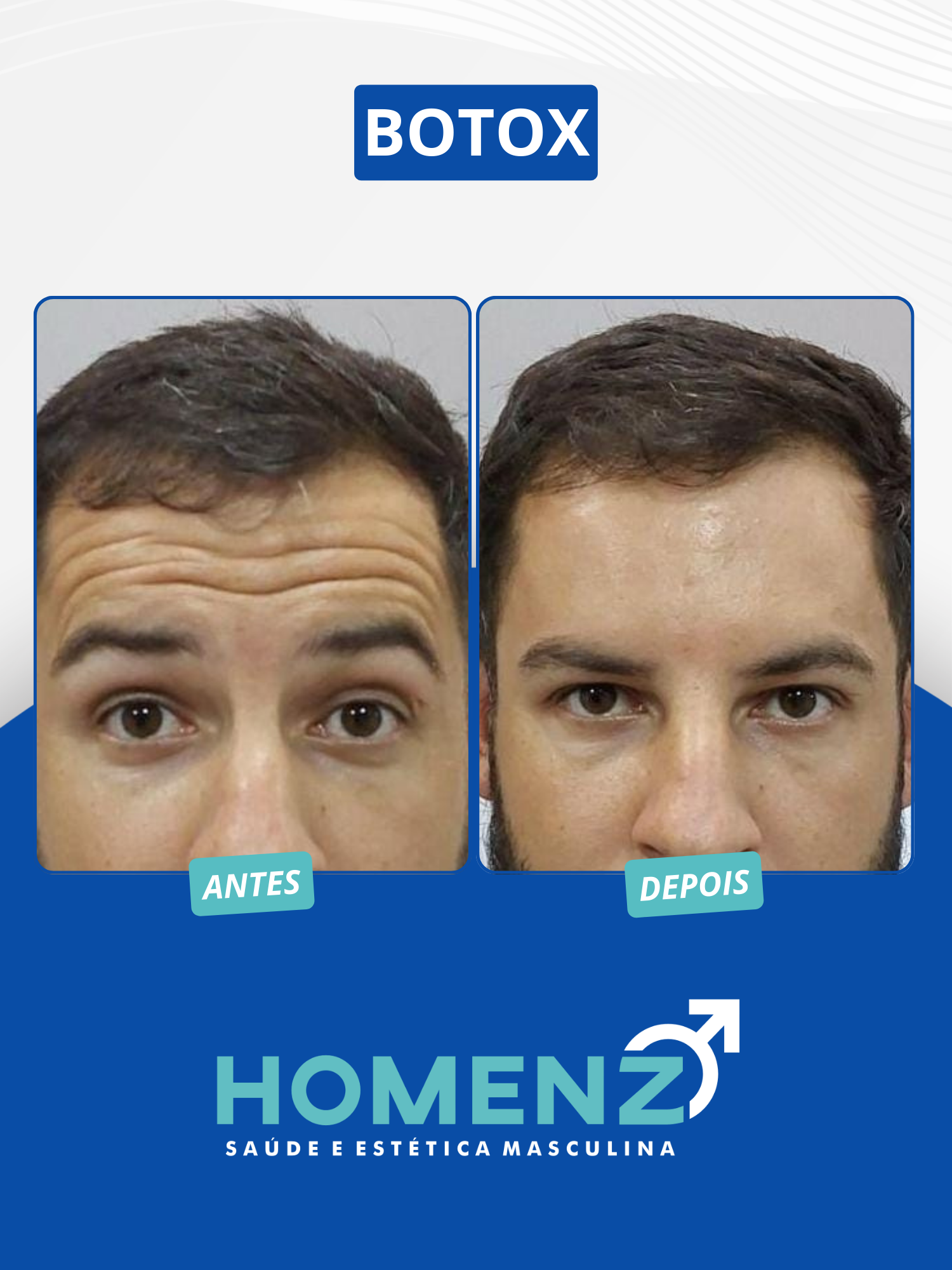 BOTOX