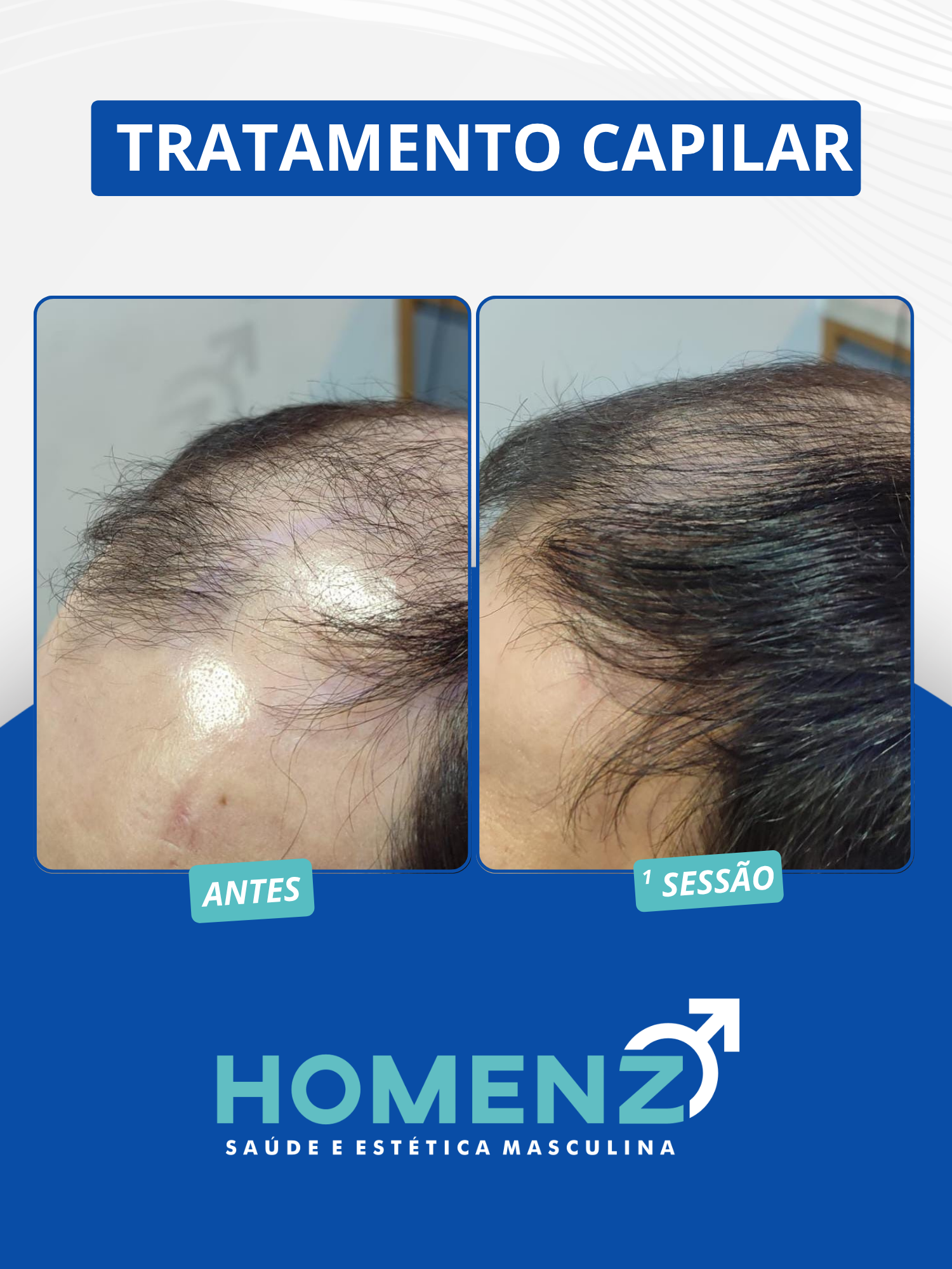 CAPILAR 02
